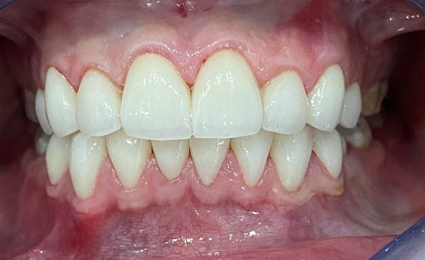 Smiling patient at Australian Dental Clinic